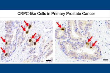 Cellular heterogeneity in prostate cancer- figure 2