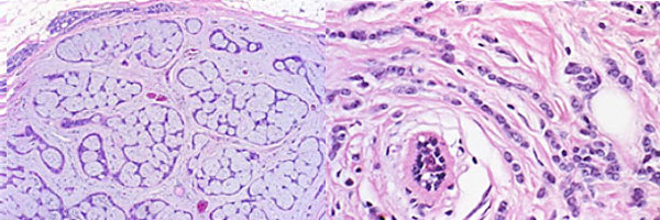 Breast Lesions, Resources, Dept. of Laboratory Medicine & Pathology