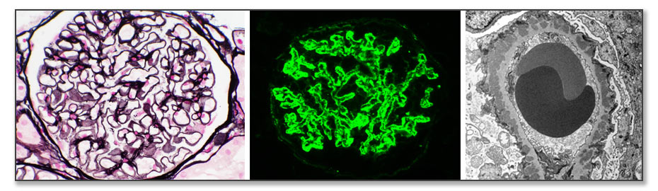 Renal biopsy