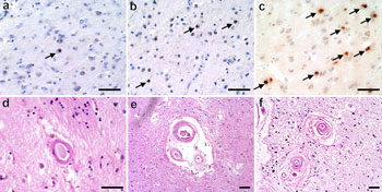 LATE pathology graphic