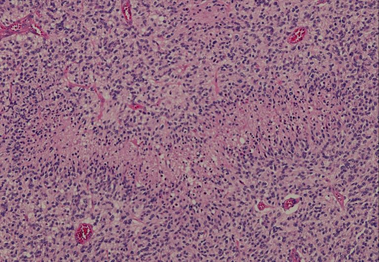 Glioblastoma tumor microenvironment