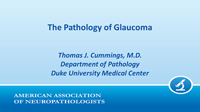 Dr. Cummings' lecture slide: The Pathology of Glaucoma