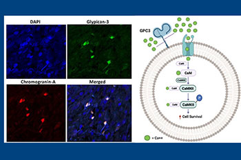 Neuroendocrine Cells in prostate cancer figure 1