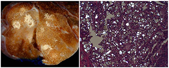 Gross photograph demonstrating multifocal white, chalky consolidations (left), and microscopic photograph displaying fibroinflammatory infiltrate with large, polarizing rhomboid crystals, consistent with barium sulfate material (right).