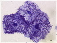 Micrograph showing uroepithelial cells shed from a patient with a UTI