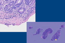 Artificial intelligence algorithm highlights a focus of intestinal metaplasia (low-power image with AI overlay on right) 