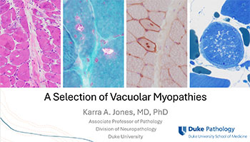 "Vacuolar Myopathies" title slide