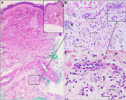 Figure Dr. Lee created demonstrating the histologic features of involutional lipoatrophy/lipodystrophy: A, Low-power view (4×, hematoxylin and eosin [H&E]), of patient's excisional right leg skin biopsy, demonstrating epidermis, dermis, and atrophic subcutaneous fat. Inset of A (4×, H&E): Low-power view of age-, gender-, and site-matched skin excision demo