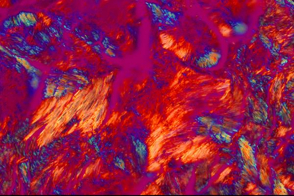 Gout crystals