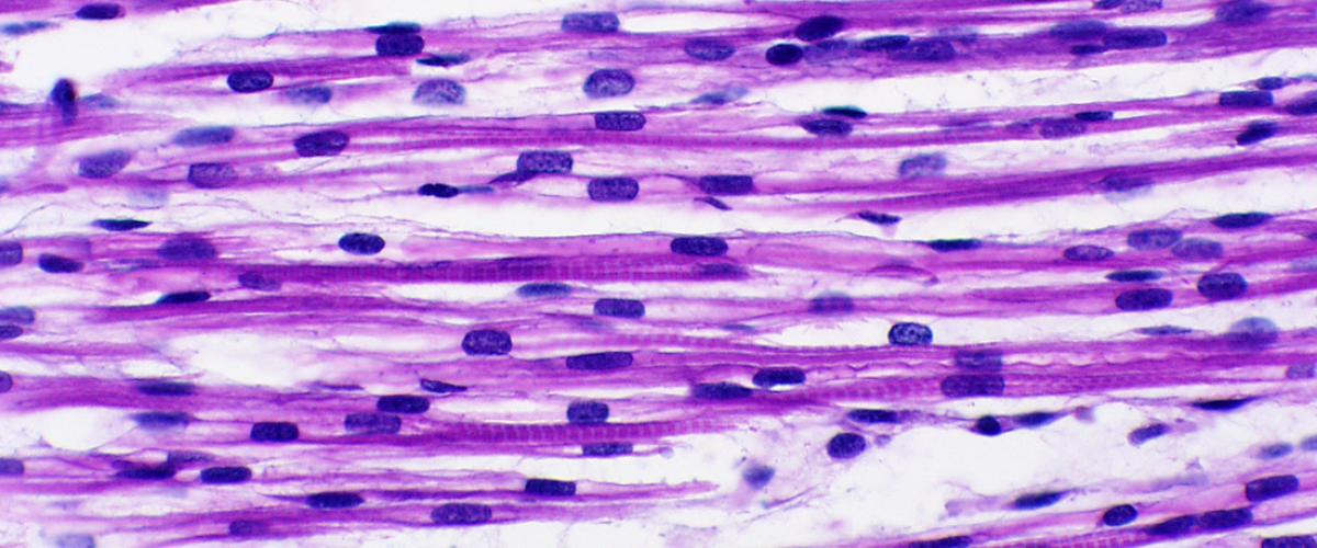 Teratoma, immature, retroperitoneal, myotubes, rhabdomyoblasts